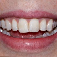 Composite Bonding - Smile 25 before